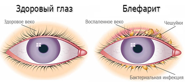 Макситрол (Maxitrol) глазные капли. Цена, инструкция по применению, аналоги