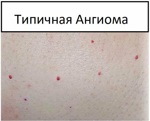 Ангиомы на теле у женщин. Причины появления, лечение и удаление