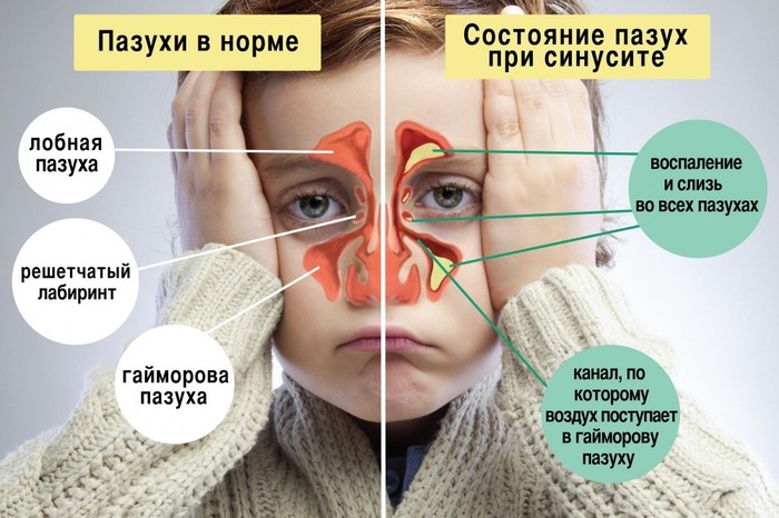 Антибиотики при синусите у взрослых. Цены, отзывы