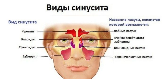 Антибиотики при синусите у взрослых. Цены, отзывы