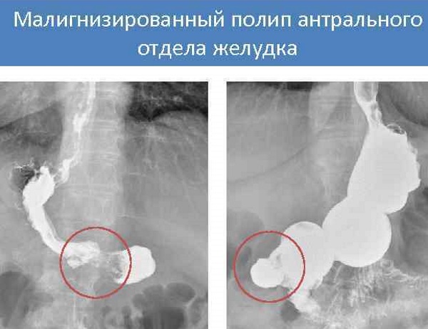 Антральный отдел желудка. Что это такое, где находится, анатомия, симптомы заболеваний и лечение