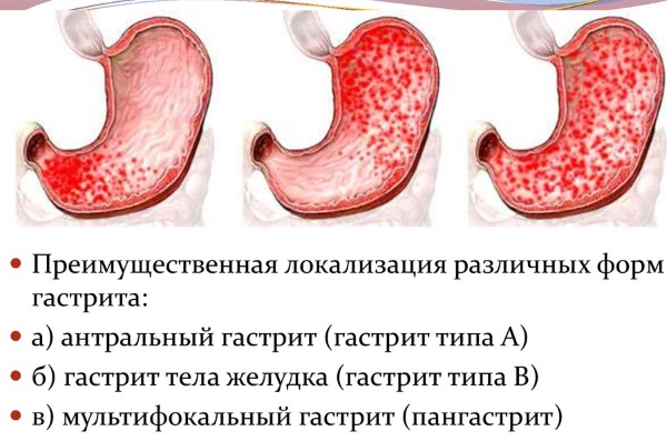 Антральный отдел желудка. Что это такое, где находится, анатомия, симптомы заболеваний и лечение