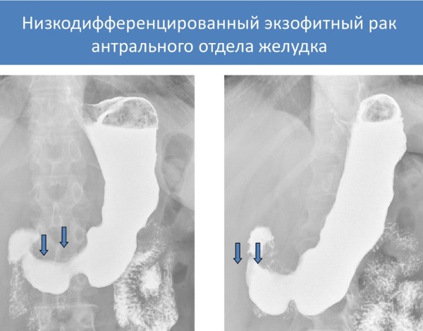Антральный отдел желудка. Что это такое, где находится, анатомия, симптомы заболеваний и лечение