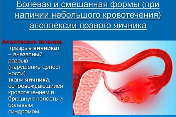 Апоплексия яичника. Что это такое, симптомы, как лечить, последствия выжигания, рекомендации