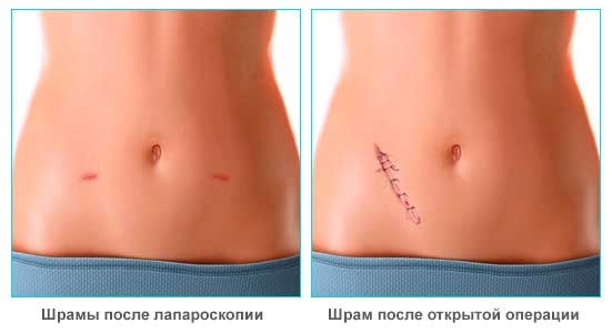 Аппендицит. Симптомы у взрослых мужчин. Стадии, осложнения, диагностика, УЗИ, лечение, диета, операция