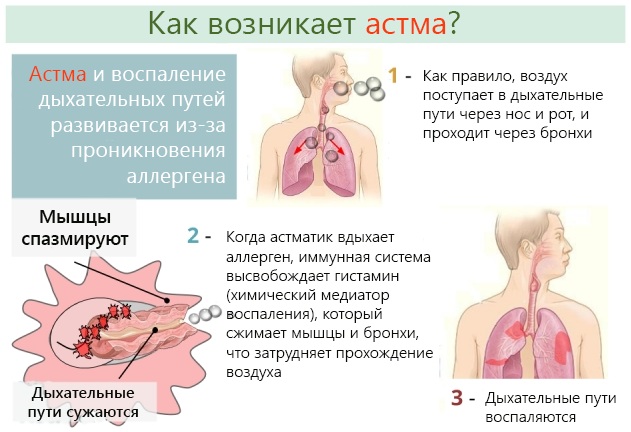 Инспираторная одышка. Характерна для чего, что это такое, заболевания