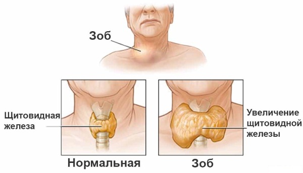 Антитела к тиреоглобулину повышены у женщин. Причины, симптомы, лечение