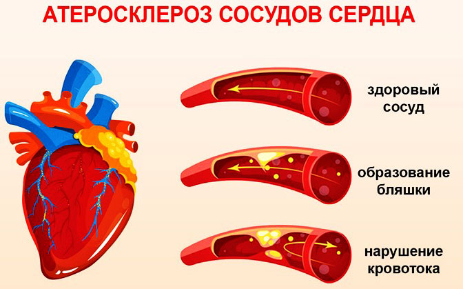 Атеросклероз сосудов сердца. Симптомы и лечение у пожилых людей, причины