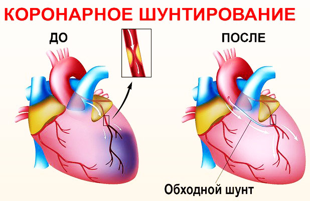 Атеросклероз сосудов сердца. Симптомы и лечение у пожилых людей, причины