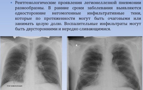 Атипичная пневмония. Симптомы у детей, взрослых, лечение, заразна или нет