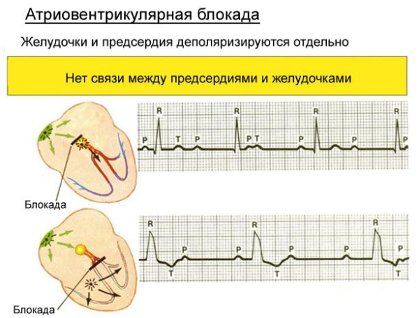 АВ блокада 1-2-3 степени на ЭКГ Мобитц. Что это, причины, лечение