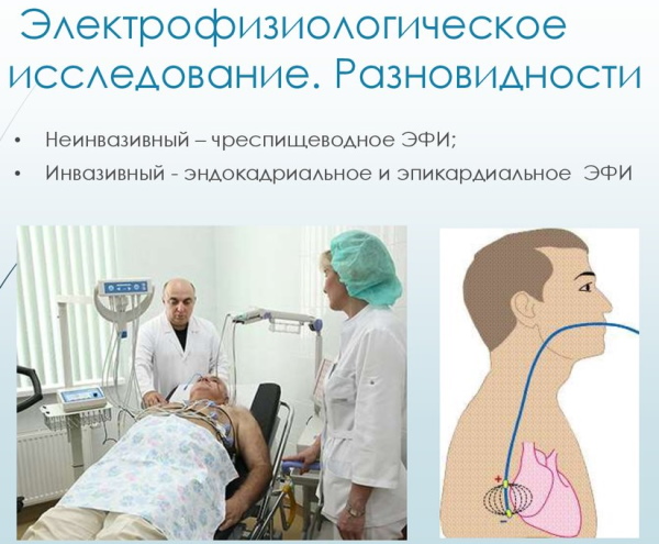 АВ блокада 1-2-3 степени на ЭКГ Мобитц. Что это, причины, лечение
