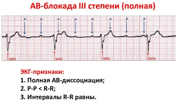 АВ блокада 1-2-3 степени на ЭКГ Мобитц. Что это, причины, лечение