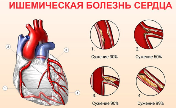 АВ блокада 1-2-3 степени на ЭКГ Мобитц. Что это, причины, лечение