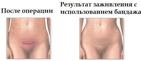 Бандаж послеоперационный на брюшную полость. Как выбрать размер, сколько носить, цена