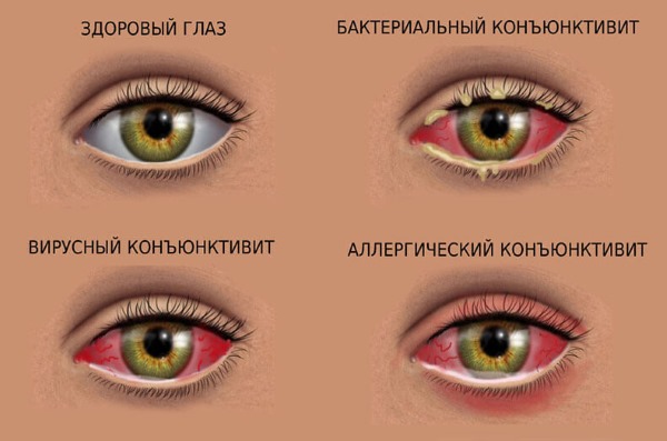Бартолинит у женщин. Симптомы и лечение, стадии, антибиотики, мази, операция