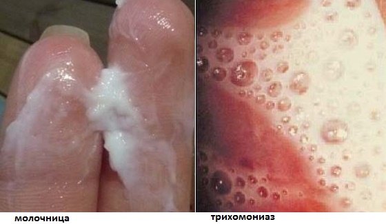 Белый налет на влагалище, стенках внутри при беременности