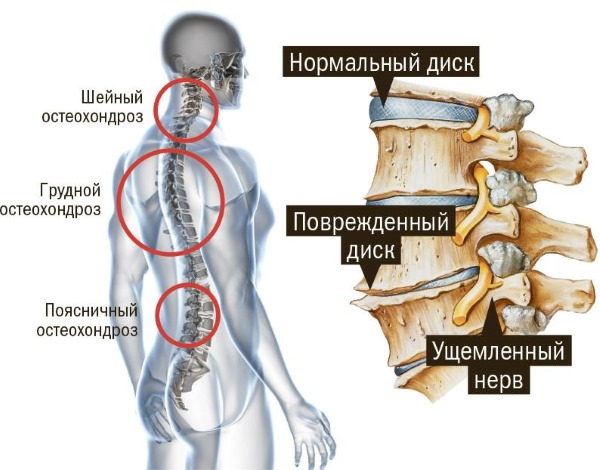 Бишофит. Применение в домашних условиях: аппликации, ванны при онкологии, пяточной шпоре, варикозе, артрозе. Свойства, инструкция, показания, противопоказания