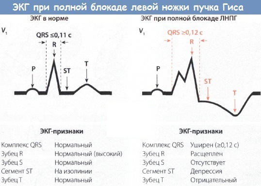 Блокада правой/левой ножки пучка Гиса, неполная, полная, задней/передней ветви. Что это такое, признаки, что делать