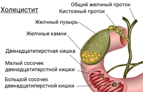 Признаки желтухи у взрослых, фото, как передается, лечение