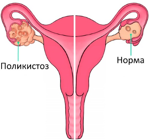 17-ОН прогестерон повышен у женщин при беременности, мужчин. Причины, что это значит, что делать, лечение