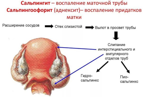 Воспаление матки и придатков. Симптомы и лечение, что это такое, причины, препараты, таблетки, народные средства