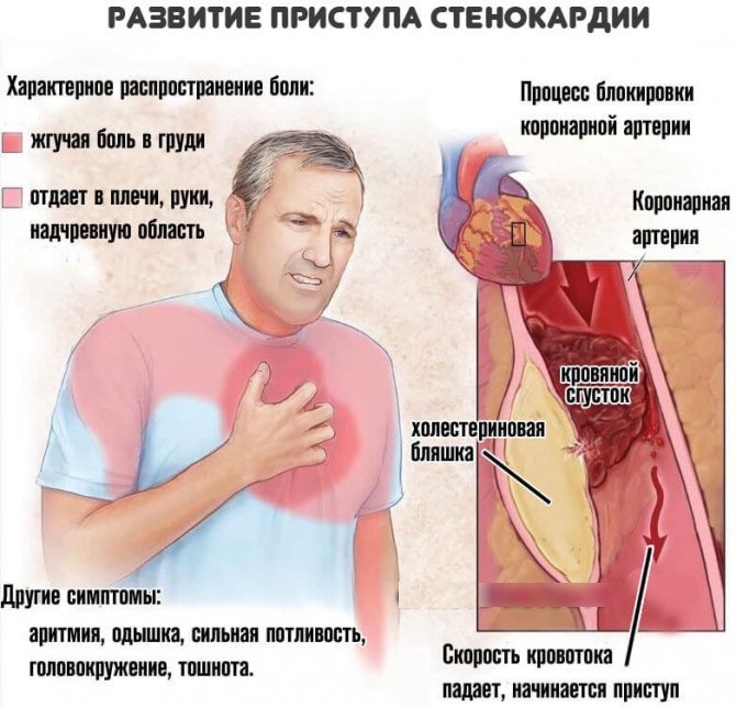 Диф. диагностика инфаркта миокарда. Таблица
