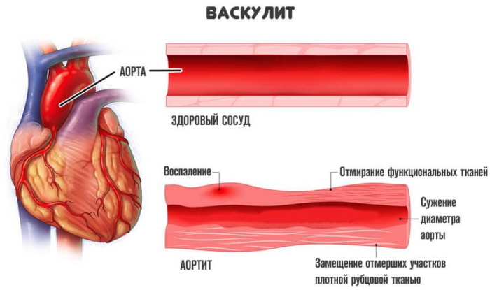Болезнь Бехчета. Что это, симптомы, лечение