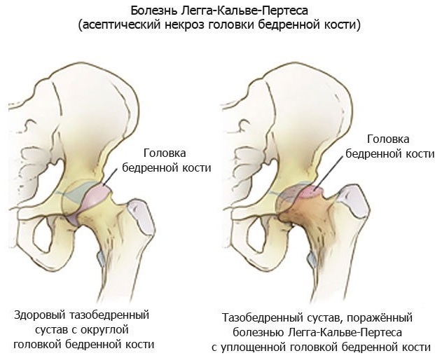 Болезни тазобедренного сустава у женщин. Симптомы, первые признаки, лечение, причины