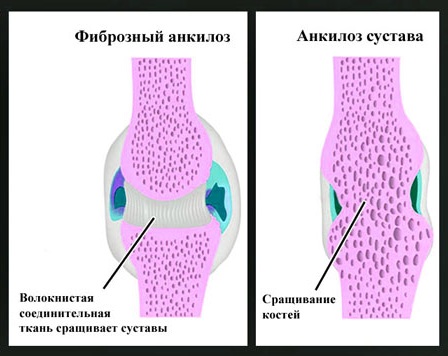 Болезни тазобедренного сустава у женщин. Симптомы, первые признаки, лечение, причины