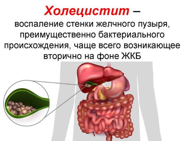 Болезни желчного пузыря у женщин, мужчин и детей. Симптомы и лечение народными средствами, препараты