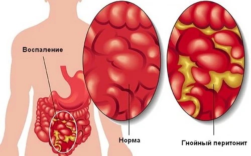 Воспаление желчных протоков. Симптомы и лечение