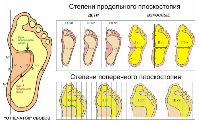 Болят ступни ног по утрам при наступании. Причины жжения, после родов, долгой ходьбы, сна. Лечение народными средствами, препараты