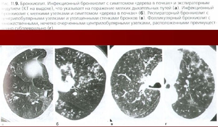 Бронхиолит. Симптомы и лечение у взрослых, что это, клинические рекомендации