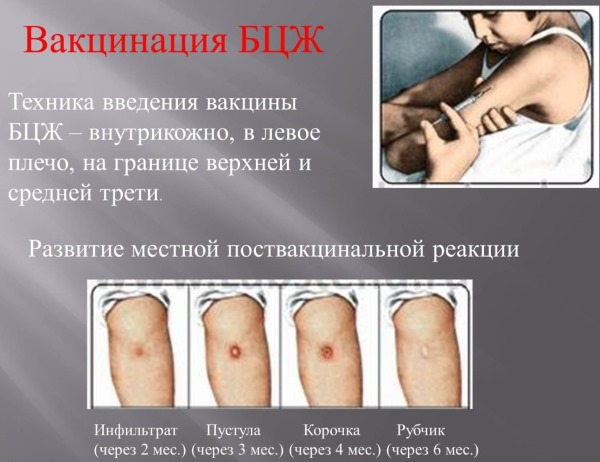 БЦЖ прививка: от чего, что это такое, когда делают новорожденным, как протекает реакция, сколько раз делается, осложнения, противопоказания