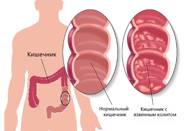 Ферменты поджелудочной железы. Препараты, что расщепляют, функции