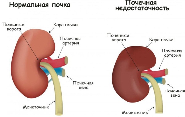 Синдром токсического шока (СТШ). Что это такое, симптомы, как избежать, лечить