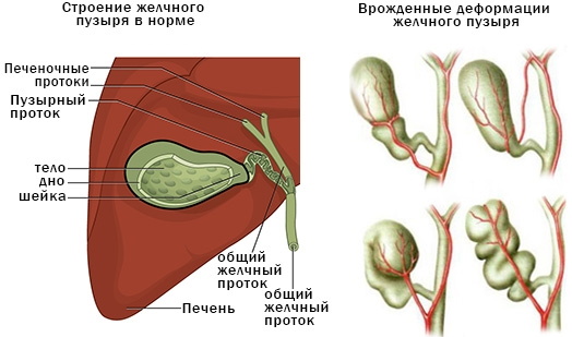 Деформация желчного пузыря у взрослого. Что это, причины, симптомы, лечение