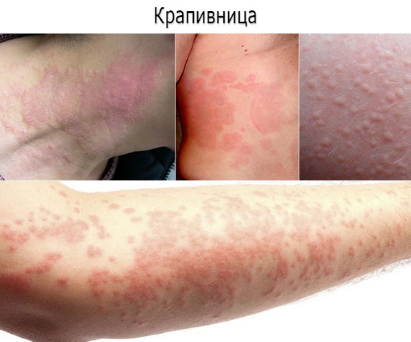 Мазь Флеминга (Ointment Flemings). Цена, отзывы, инструкция по применению, аналоги