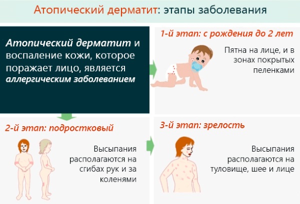 Дерматит у ребенка. Фото, симптомы и лечение контактный, аллергический, перианальный, пелёночный, атопический