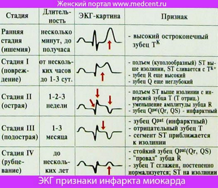 Диф. диагностика инфаркта миокарда. Таблица