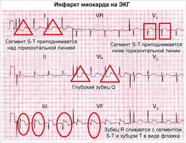 Диф. диагностика инфаркта миокарда. Таблица