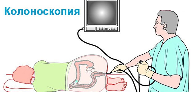 Дисбиоз кишечника. Что это такое у женщин, мужчин и детей. Симптомы и лечение