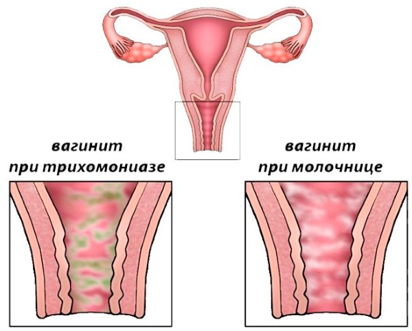 Дисбиоз с преобладанием условно патогенных анаэробных микроорганизмов кишечника, в гинекологии: выраженный, умеренный