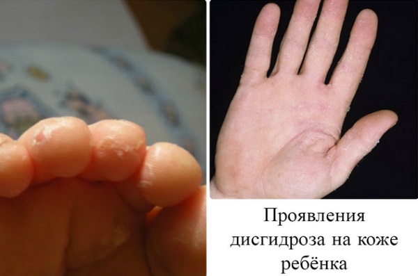 Дисгидроз кистей рук и стоп. Фото у детей, лечение, народные средства