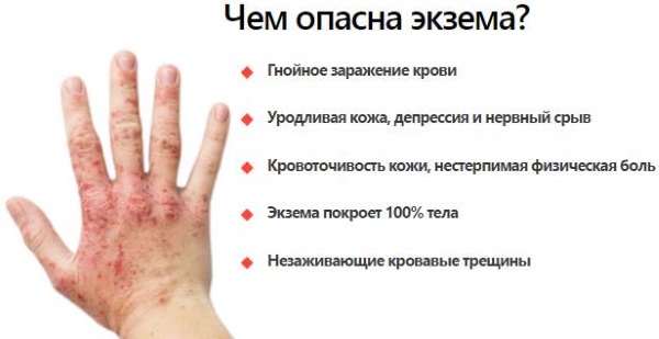 Экзема на руках. Как вылечить навсегда народными средствами, мазями. Диета, образ жизни