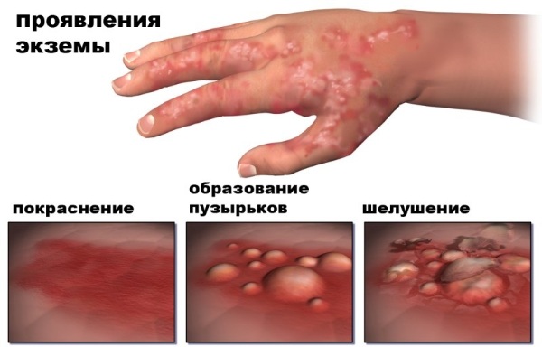 Экзема. Симптомы и лечение на ногах и руках, лице, в уголках губ. Народные средства, препараты