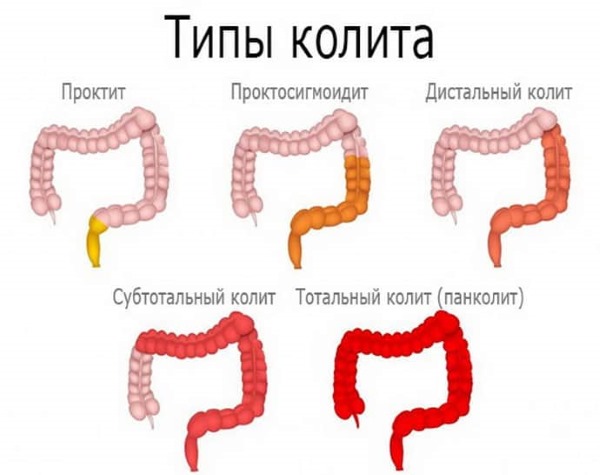 Энтерофурил. Инструкция по применения для детей (суспензия, капсулы). Цена, аналоги, отзывы