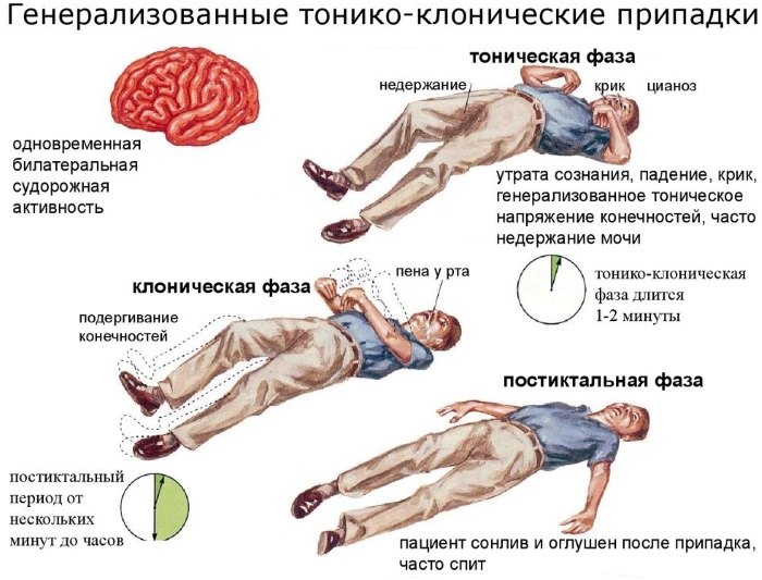 Эпилепсия у детей. Причины возникновения, симптомы, лечение, клинические рекомендации