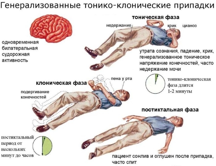 Эпилепсия у грудничков. Симптомы, первые признаки, причины, лечение